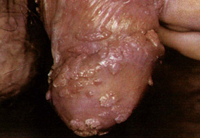 Genital warts: lesion of the penis