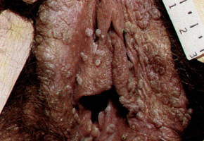 Genital warts: lesion of vulva