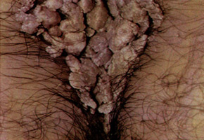 Genital warts: lesion of perianal zona