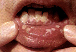 Herpes: primary infection is Herpetic Stomatitis. Multiple and very painful erosion on the mucous membrane of the lower lip.