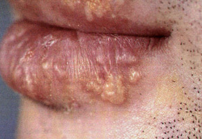 Orofacial Herpes