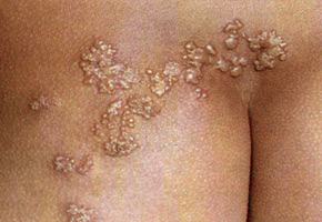Herpes zoster: the lesion of one dermatome. Pathogen is varicella-zoster virus.