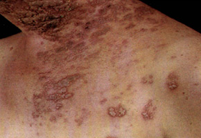 Herpes Zoster: the lesion of several adjacent dermatomes.