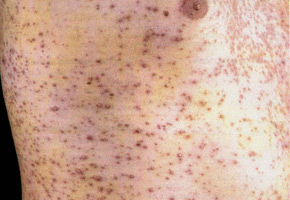 Herpes Zoster associated with the immunodeficiency: disseminated skin lesion.