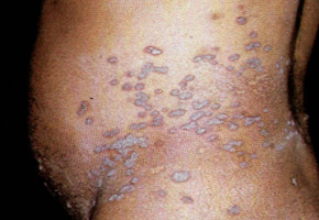 Herpes Zoster with a long-lasting localized skin lesion.