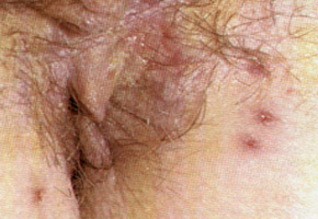 Genital Herpes: recurrence