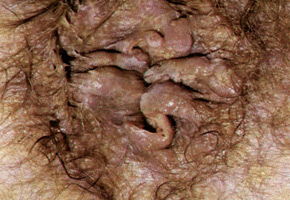 Genital Herpes: Herpetic Proctitis