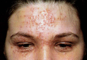 Eczema Herpetic of Kaposi