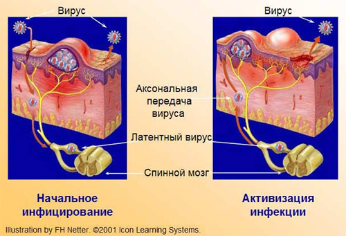 Mechanism of genital herpes development (herpes infection) 