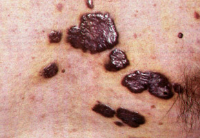 Kaposi Sarcoma: an epidemic case, plaque phase